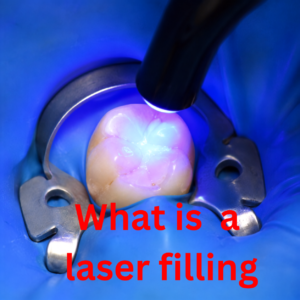 What is a laser filling